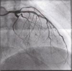 stent2.jpg