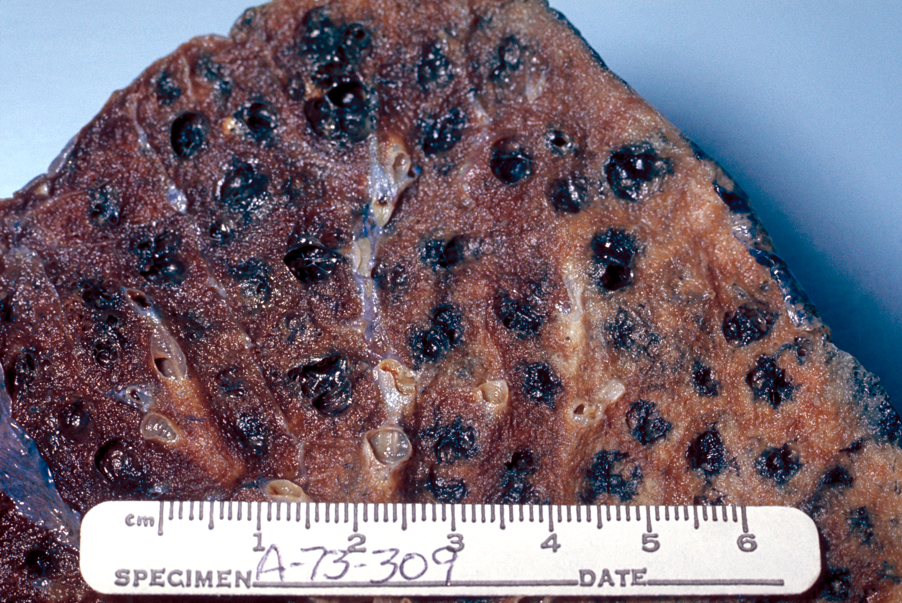 Centrilobular_emphysema_865_lores.jpg