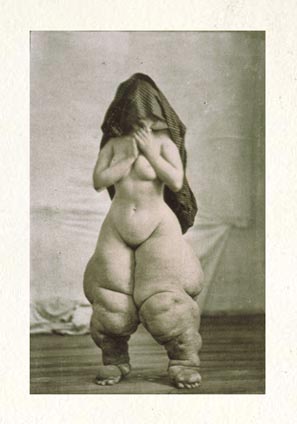 Elephantiasis.jpg