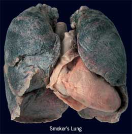 smokers-lung-22312.jpg