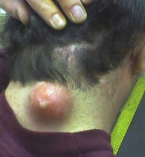 huge-neck-pimple.jpg