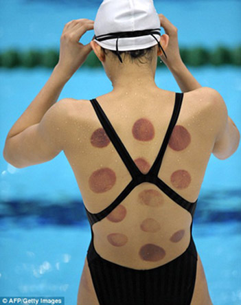 cupping.jpg