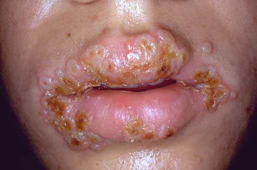 herpes-mouth.jpg